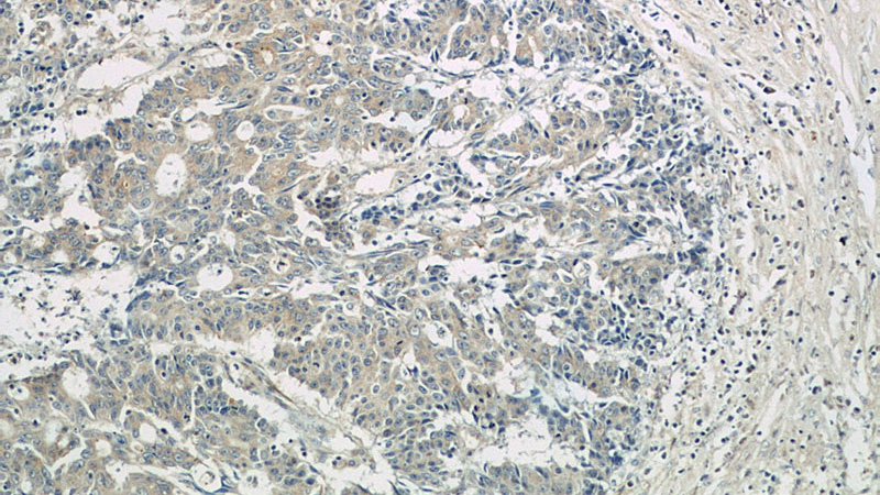 Immunohistochemistry of paraffin-embedded human colon cancer tissue slide using Catalog No:113405(NUBPL Antibody) at dilution of 1:50 (under 10x lens)