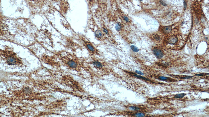 Immunohistochemistry of paraffin-embedded human breast cancer tissue slide using Catalog No:110749(FUT7 Antibody) at dilution of 1:50 (under 40x lens)