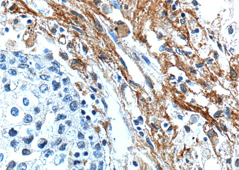 Immunohistochemistry of paraffin-embedded human lung cancer tissue slide using Catalog No:110240(EMILIN2 Antibody) at dilution of 1:200 (under 40x lens).