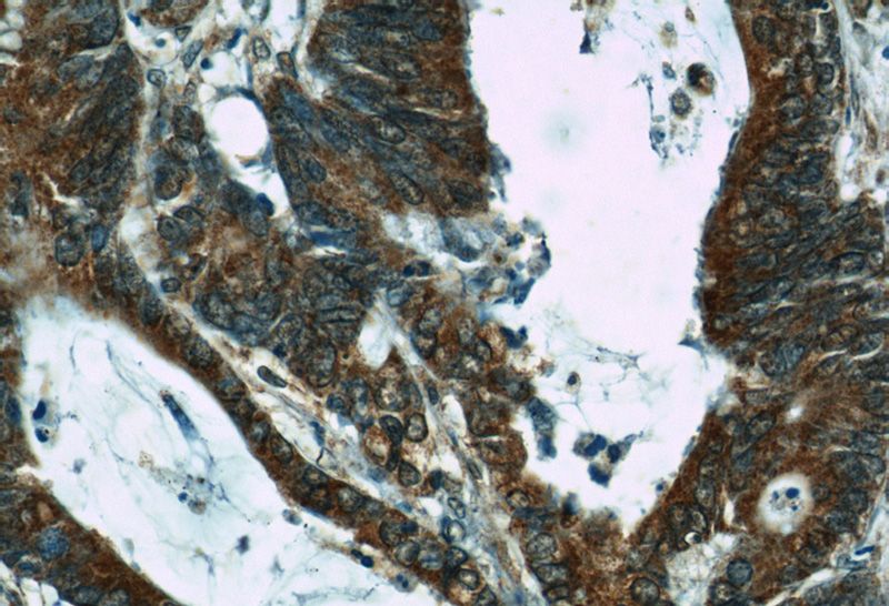 Immunohistochemical of paraffin-embedded human colon cancer using Catalog No:110363(ERK1 antibody) at dilution of 1:50 (under 40x lens)