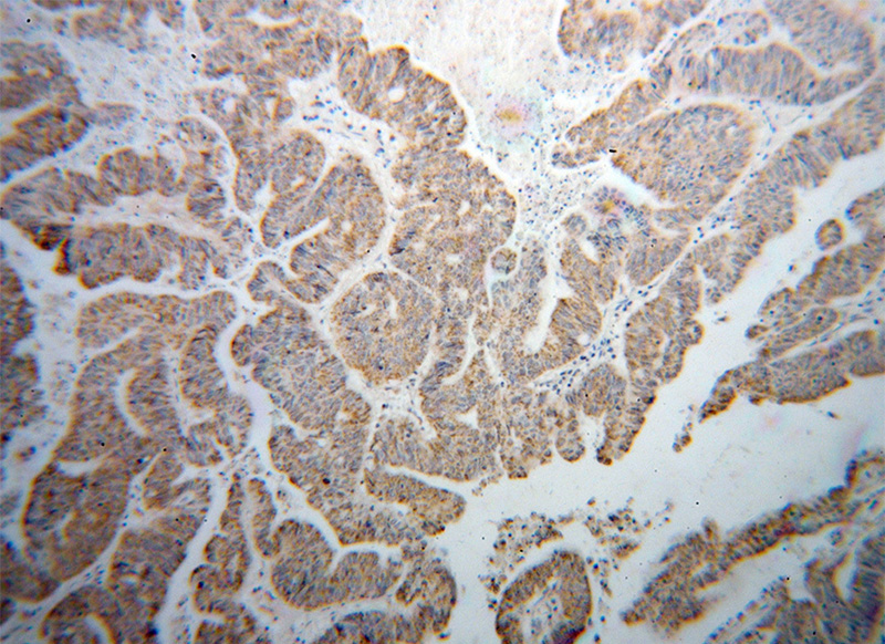 Immunohistochemical of paraffin-embedded human liver cancer using Catalog No:117107(BCO2 antibody) at dilution of 1:50 (under 10x lens)