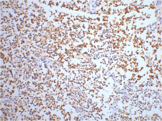 IHC staining of Human small cell carcinoma of lung tissue with NSEmouse mAb(13E2) diluted at 1:200.