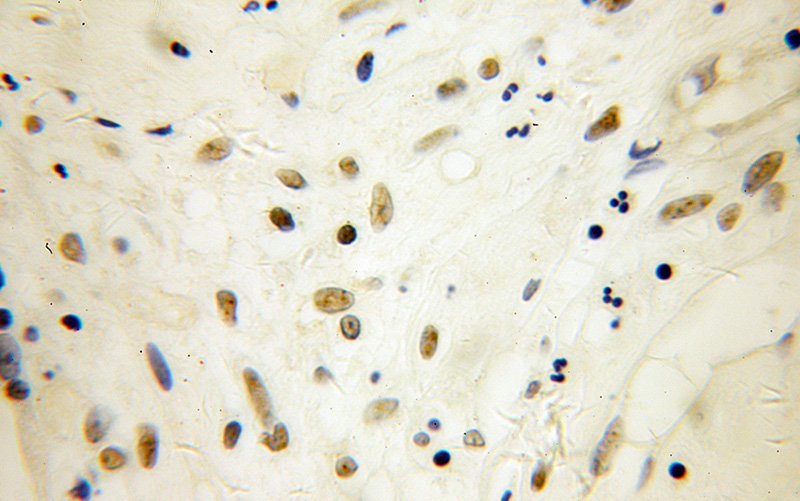 Immunohistochemical of paraffin-embedded human ovary tumor using Catalog No:115522(SP100 antibody) at dilution of 1:50 (under 40x lens)