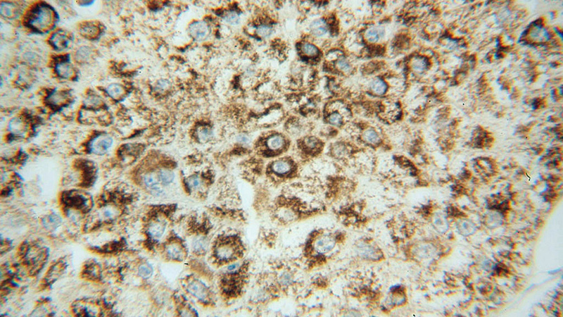 Immunohistochemical of paraffin-embedded human liver cancer using Catalog No:113260(NNT antibody) at dilution of 1:50 (under 40x lens)