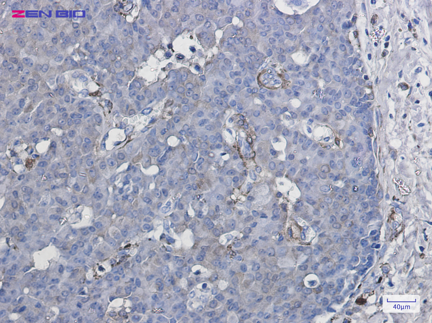 Immunohistochemistry of CYP1B1 in paraffin-embedded Human breast cancer tissue using CYP1B1 Rabbit pAb at dilution 1/50