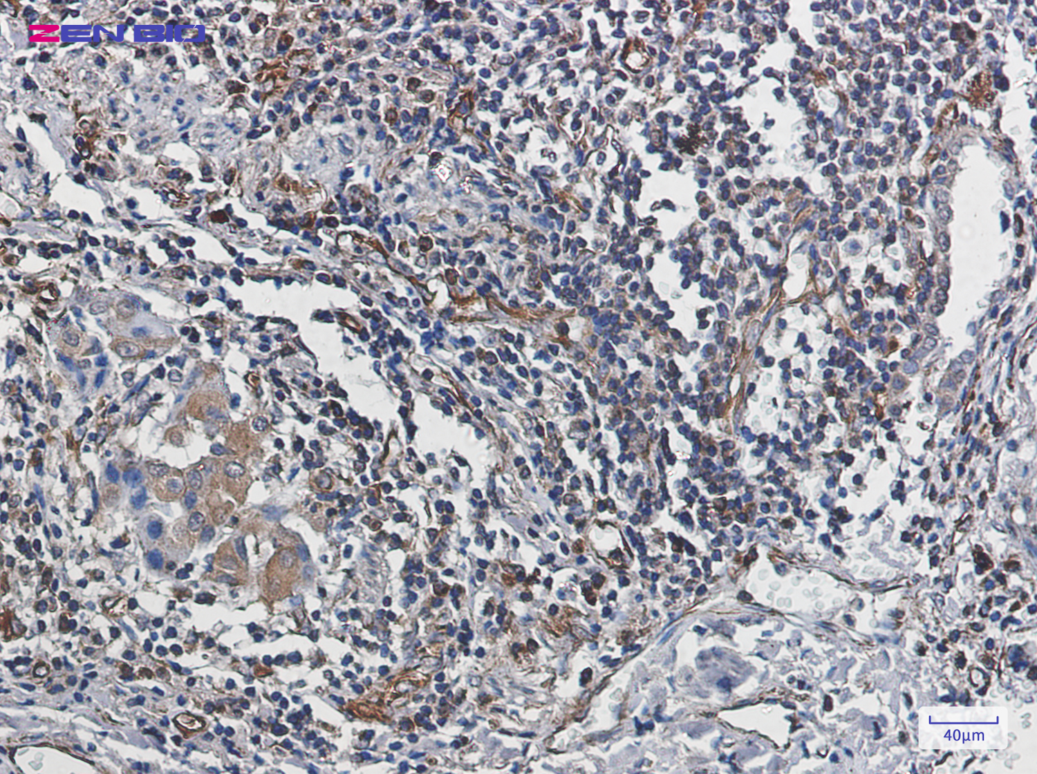 Immunohistochemistry of Caspase-10 in paraffin-embedded Human lung cancer tissue using Caspase-10 Rabbit pAb at dilution 1/20