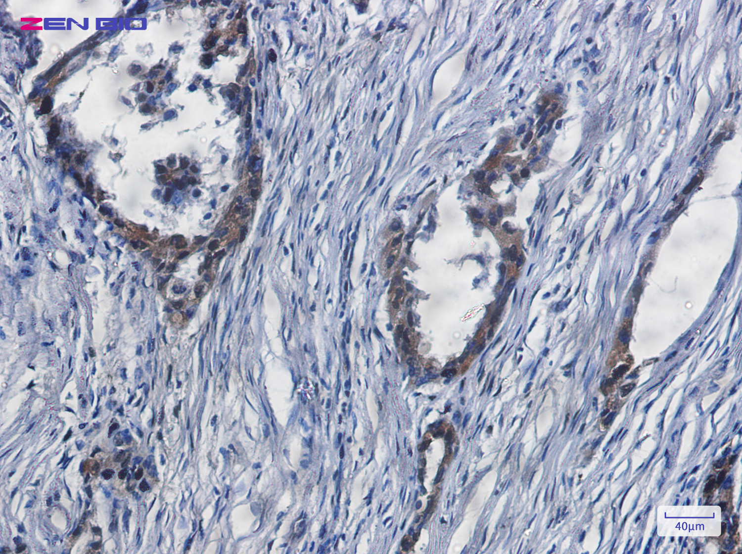 Immunohistochemistry of YAP1 in paraffin-embedded Human lung cancer tissue using YAP1 Rabbit pAb at dilution 1/20