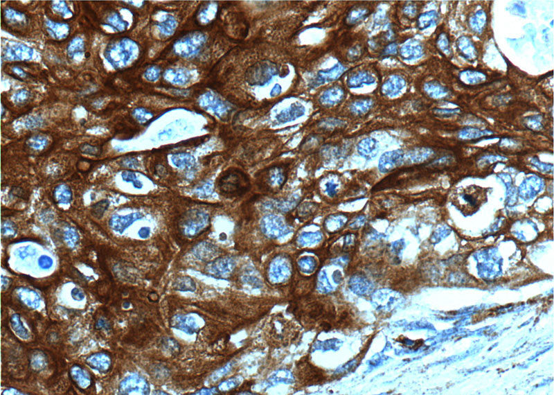 Immunohistochemistry of paraffin-embedded human cervical cancer tissue slide using Catalog No:109790(KRT13 Antibody) at dilution of 1:200 (under 40x lens).