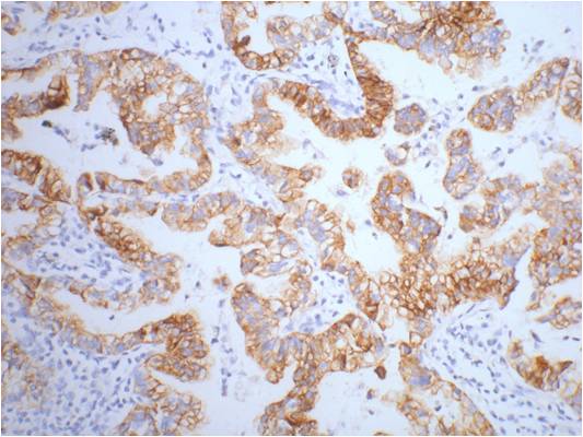 IHC staining of human lung cancer tissue, diluted at 1:200.