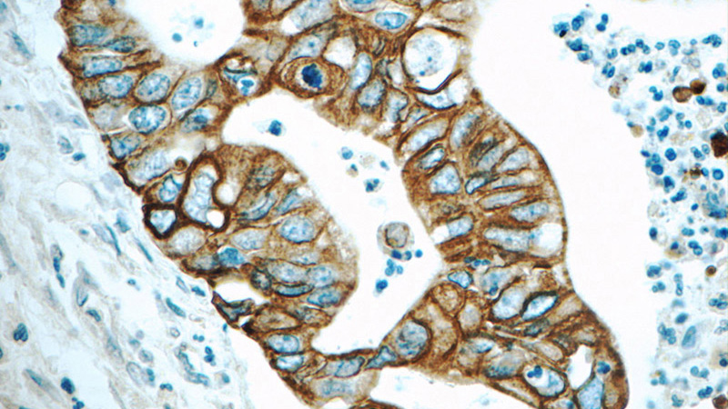Immunohistochemistry of paraffin-embedded human pancreas cancer tissue slide using Catalog No:109801(KRT19 Antibody) at dilution of 1:100 (under 40x lens)