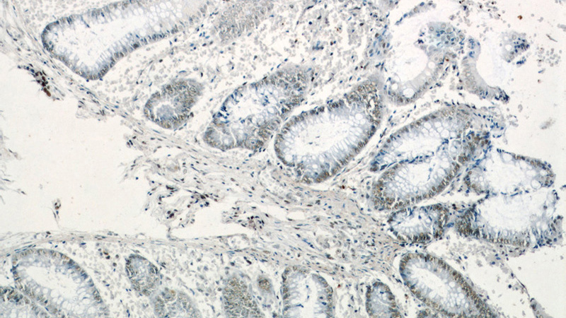 Immunohistochemistry of paraffin-embedded human colon slide using Catalog No:113139(NF45 Antibody) at dilution of 1:50
