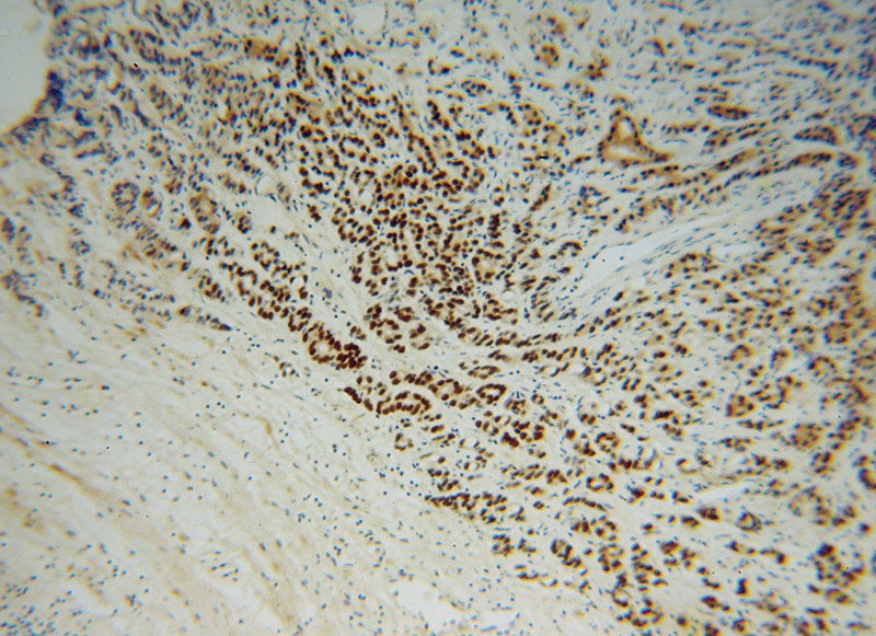 Immunohistochemical of paraffin-embedded human gliomas using Catalog No:112516(METTL1 antibody) at dilution of 1:100 (under 10x lens)