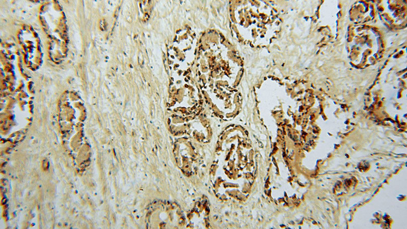 Immunohistochemical of paraffin-embedded human prostate using Catalog No:111369(hD53; TPD52L1 antibody) at dilution of 1:50 (under 10x lens)