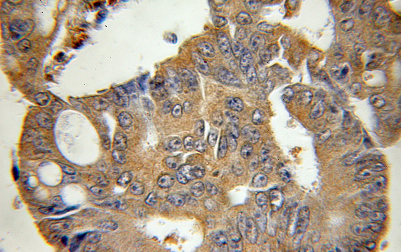 Immunohistochemical of paraffin-embedded human colon cancer using Catalog No:117142(BID antibody) at dilution of 1:100 (under 10x lens)