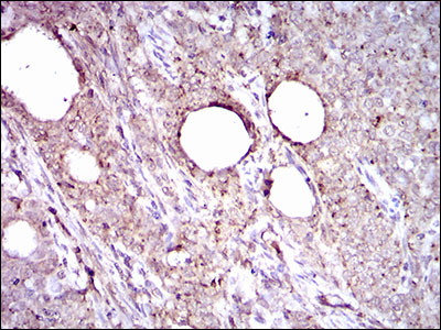 Immunohistochemical analysis of paraffin-embedded cervical cancer tissues using ALDH2 mouse mAb with DAB staining.