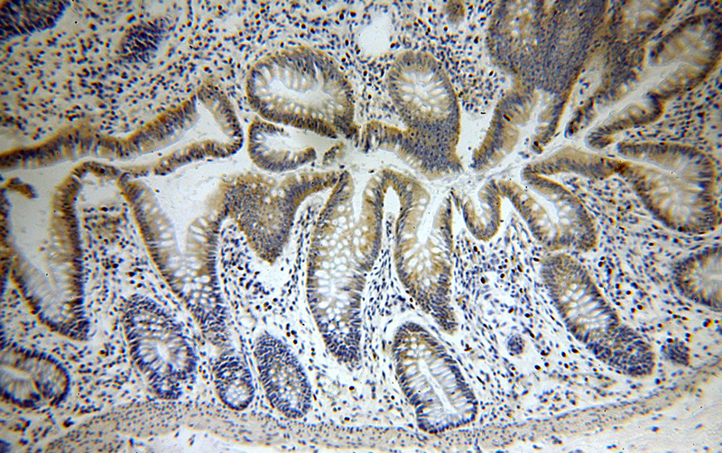 Immunohistochemical of paraffin-embedded human colon using Catalog No:113899(PIGZ antibody) at dilution of 1:100 (under 10x lens)