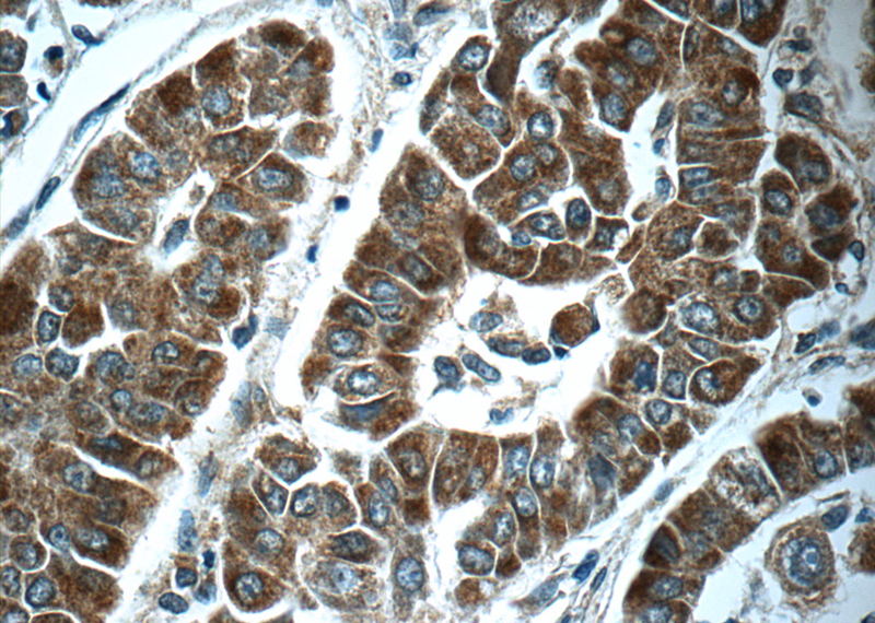Immunohistochemistry of paraffin-embedded human liver cancer tissue slide using Catalog No:107818(ABL2 Antibody) at dilution of 1:50 (under 40x lens)