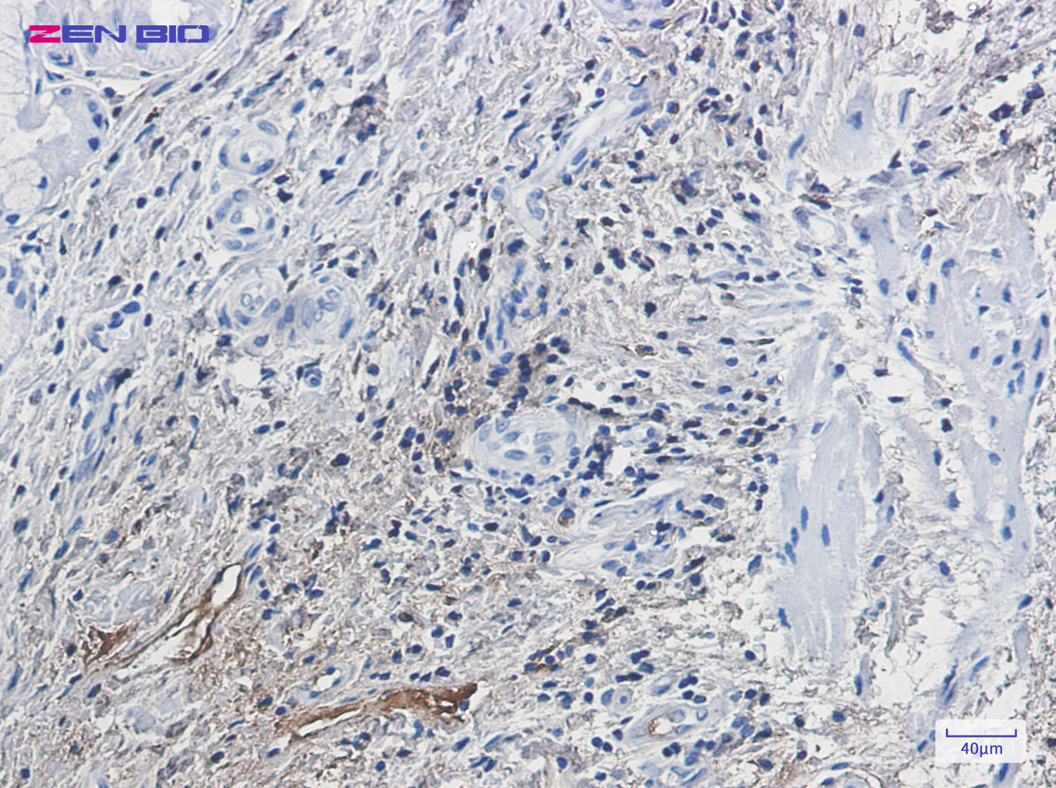 Immunohistochemistry of RAB7 in paraffin-embedded Human lung cancer tissue using RAB7 Rabbit pAb at dilution 1/20
