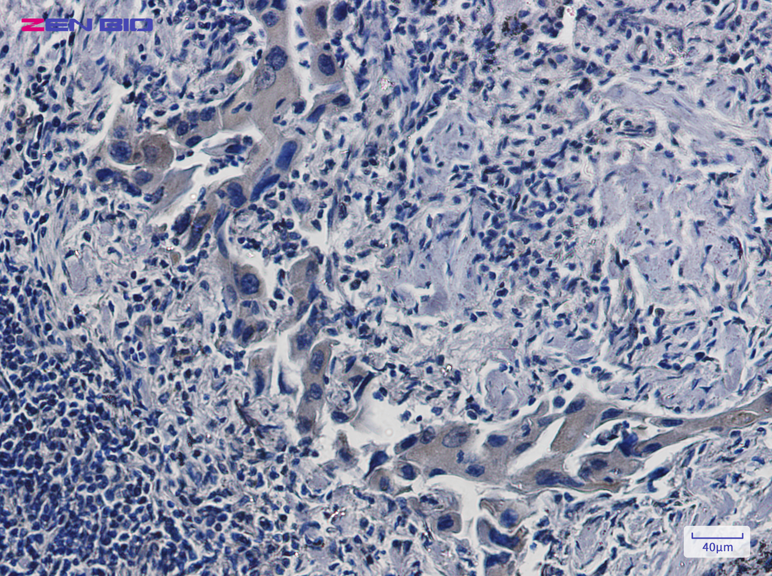 Immunohistochemistry of IGF2BP1 in paraffin-embedded Human lung cancer tissue using IGF2BP1 Rabbit pAb at dilution 1/50