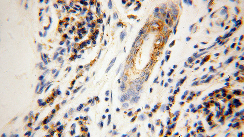 Immunohistochemical of paraffin-embedded human skin cancer using Catalog No:111015(GK3P antibody) at dilution of 1:100 (under 40x lens)