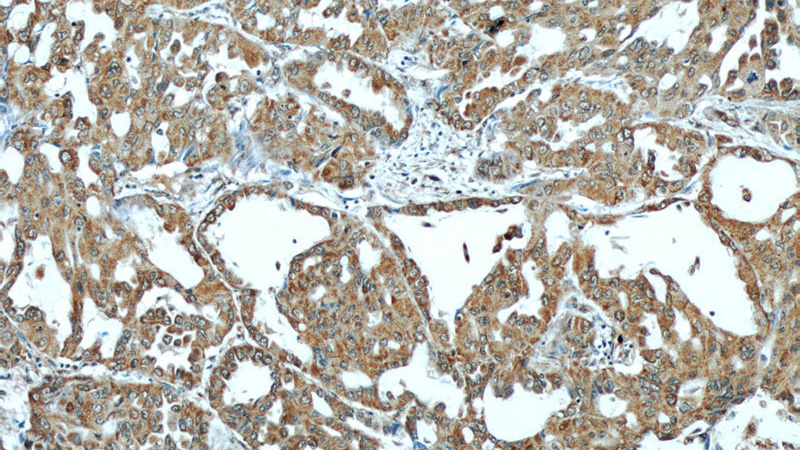 Immunohistochemical of paraffin-embedded human lung cancer using Catalog No:111798(INHBA antibody) at dilution of 1:50 (under 10x lens)