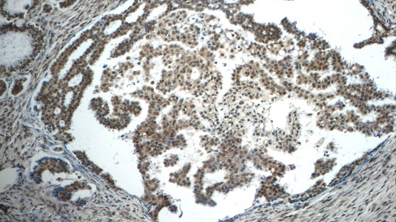 Immunohistochemistry of paraffin-embedded human ovary tumor tissue slide using Catalog No:107655(ubiquitin Antibody) at dilution of 1:50 (under 10x lens)