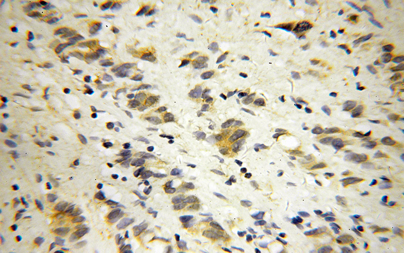 Immunohistochemical of paraffin-embedded human gliomas using Catalog No:109964(DNM3 antibody) at dilution of 1:50 (under 40x lens)