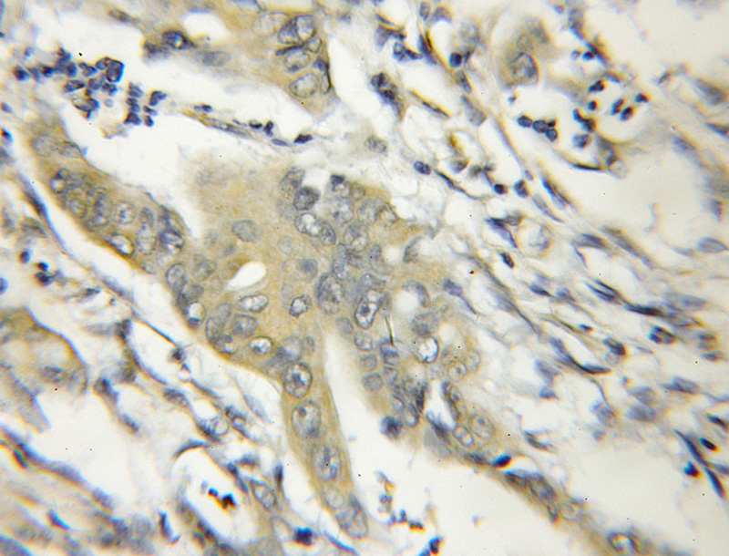 Immunohistochemical of paraffin-embedded human colon cancer using Catalog No:114126(PPIH antibody) at dilution of 1:50 (under 10x lens)