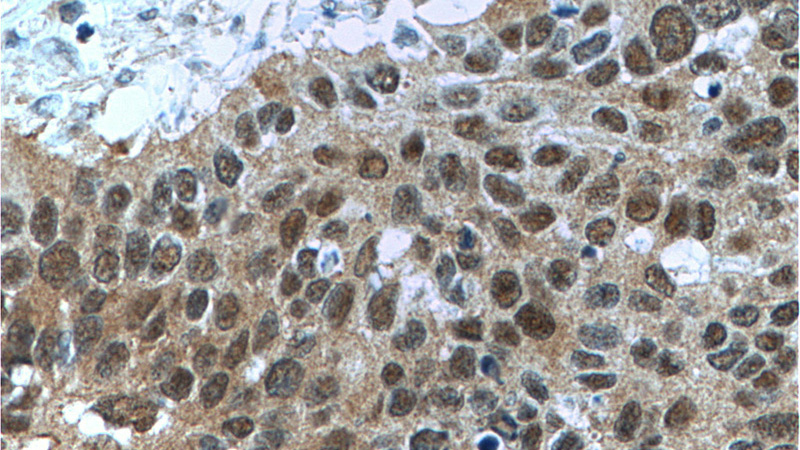 Immunohistochemistry of paraffin-embedded human cervical cancer tissue slide using Catalog No:107217(FKBP52 Antibody) at dilution of 1:200 (under 40x lens). Heat mediated antigen retrieved with Tris-EDTA buffer, pH9.0