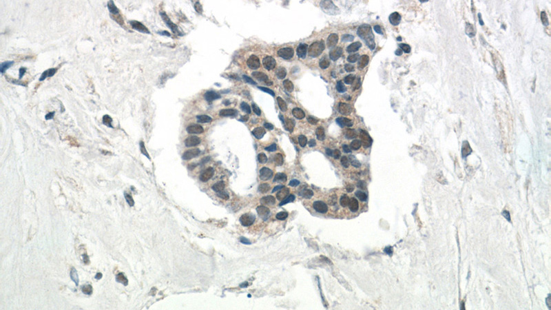 Immunohistochemistry of paraffin-embedded human breast cancer tissue slide using Catalog No:111805(INO80C Antibody) at dilution of 1:50 (under 40x lens)