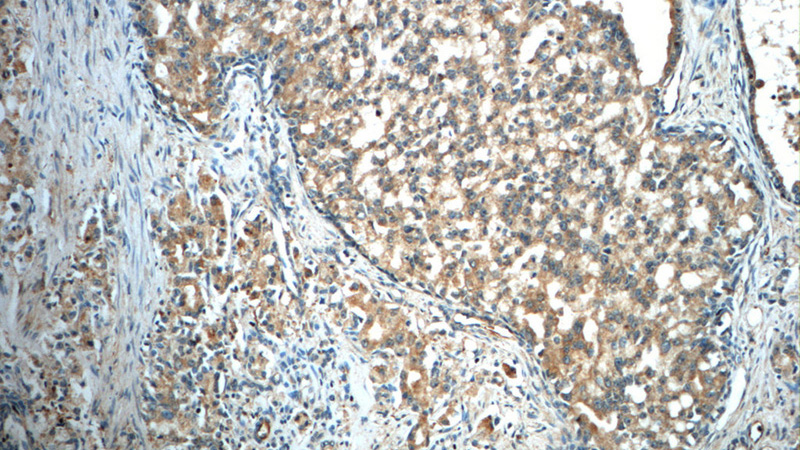 Immunohistochemistry of paraffin-embedded human prostate cancer slide using Catalog No:110923(GDEP Antibody) at dilution of 1:50. (under 10x lens)