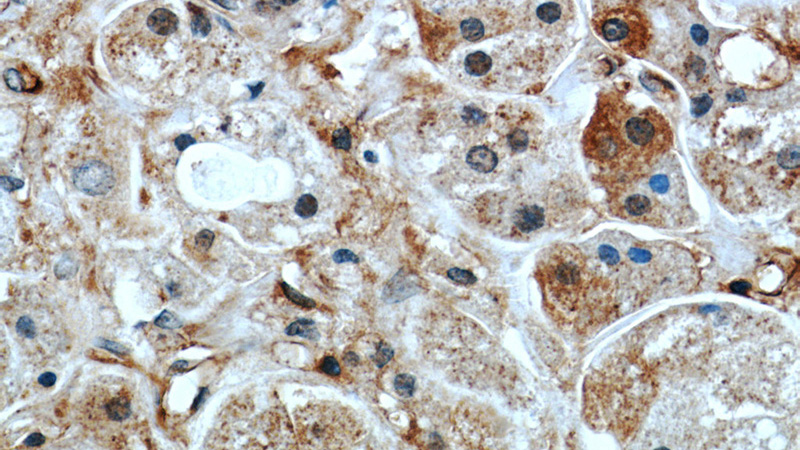 Immunohistochemistry of paraffin-embedded human breast cancer slide using Catalog No:114587(RB1CC1 Antibody) at dilution of 1:50