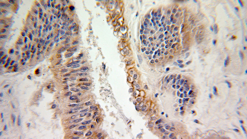 Immunohistochemical of paraffin-embedded human ovary tumor using Catalog No:108198(ARL2 antibody) at dilution of 1:100 (under 25x lens)