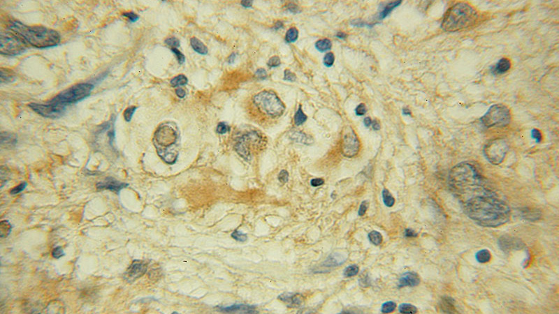 Immunohistochemical of paraffin-embedded human gliomas using Catalog No:114646(RGS3 antibody) at dilution of 1:50 (under 40x lens)