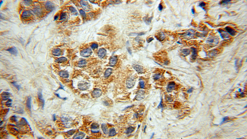 Immunohistochemical of paraffin-embedded human prostate cancer using Catalog No:113597(PARVA antibody) at dilution of 1:50 (under 10x lens)