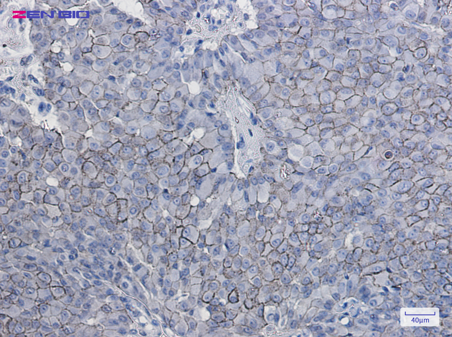 Immunohistochemistry of CD166 in paraffin-embedded Human breast cancer tissue using CD166 Rabbit pAb at dilution 1/50