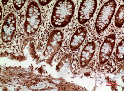 Fig2:; Immunohistochemical analysis of paraffin-embedded human-colon, antibody was diluted at 1:100