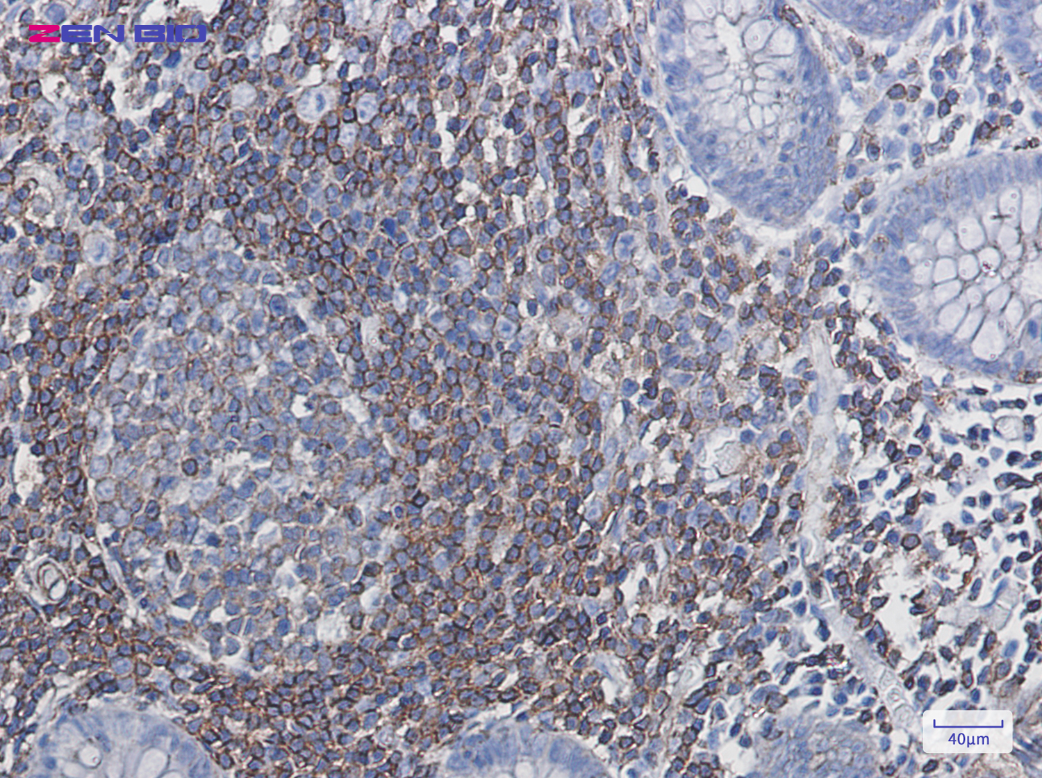 Immunohistochemistry of PHD3 in paraffin-embedded Human colon cancer tissue using PHD3 Rabbit pAb at dilution 1/50