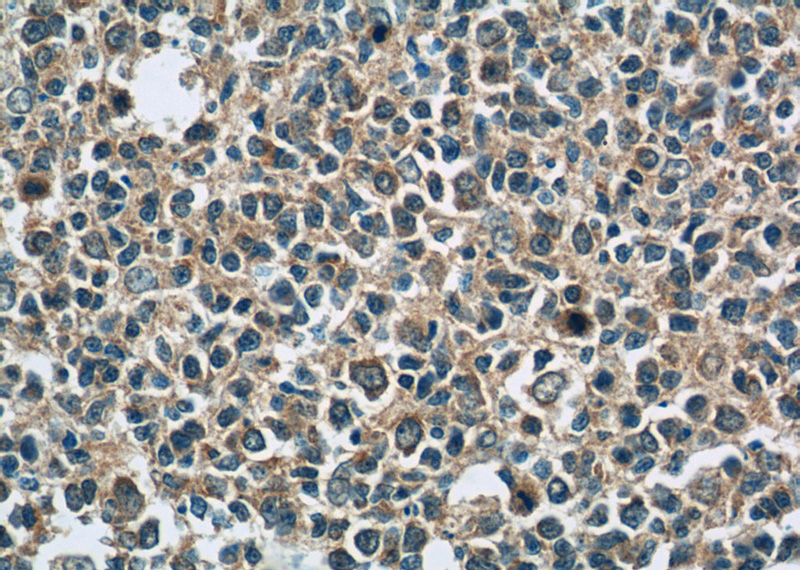Immunohistochemistry of paraffin-embedded human tonsillitis tissue slide using Catalog No:113485(PLA2G7 Antibody) at dilution of 1:50 (under 40x lens)