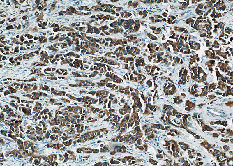 Immunohistochemical of paraffin-embedded human breast cancer using Catalog No:112646(MAP2K4 antibody) at dilution of 1:50 (under 10x lens)