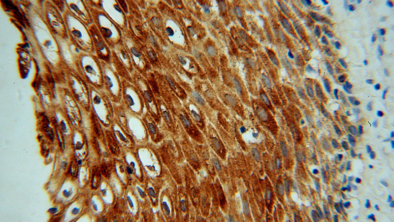 Immunohistochemical of paraffin-embedded human cervical cancer using Catalog No:112007(KIF22 antibody) at dilution of 1:100 (under 40x lens)