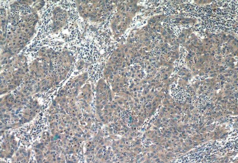 Immunohistochemistry of paraffin-embedded human cervical cancer tissue slide using Catalog No:107402(IL6 Antibody) at dilution of 1:50 (under 10x lens)