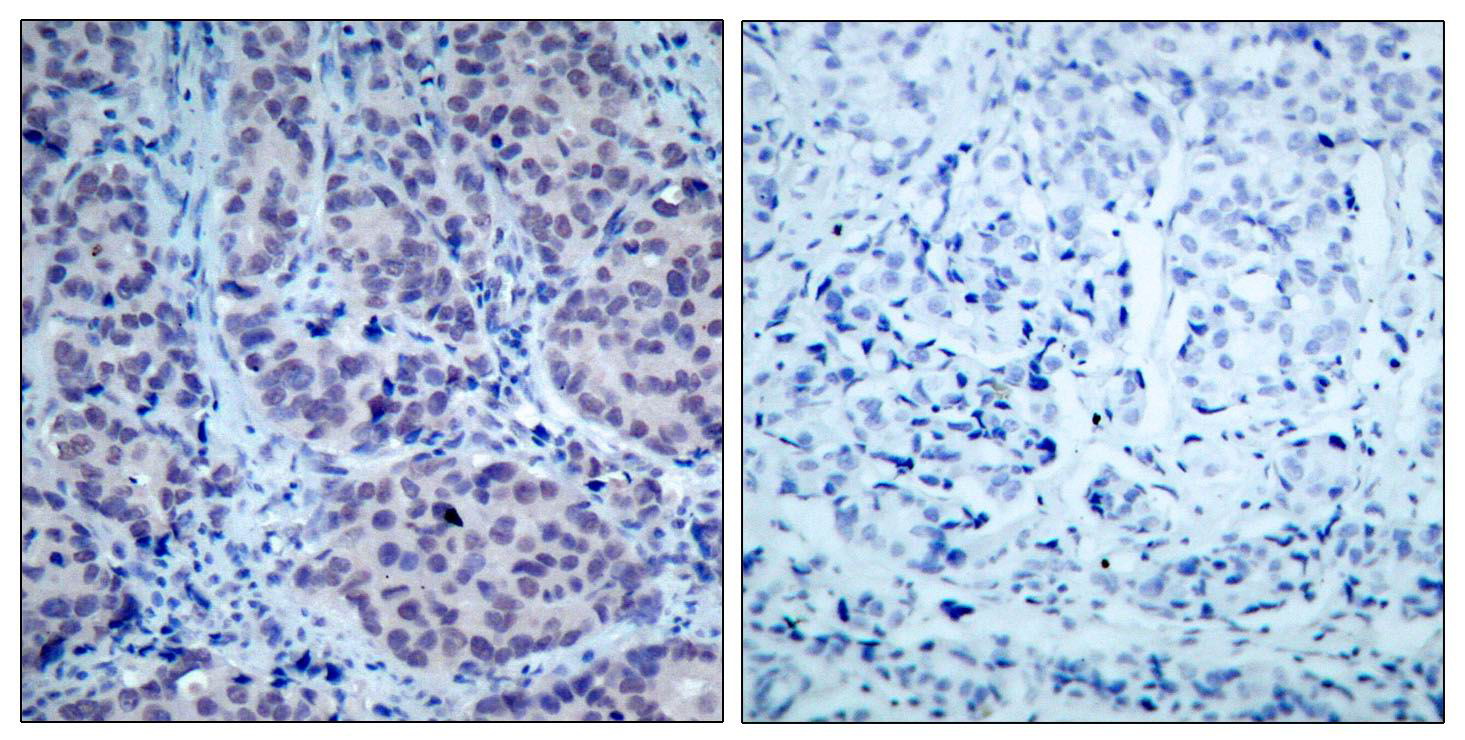 Immunohistochemical analysis of paraffin-embedded human breast carcinoma tissue using HDAC2 (Ab-394) Antibody  (left) or the same antibody preincubated with blocking peptide (right).