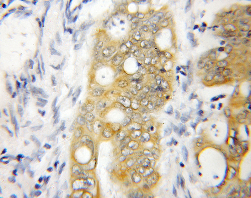 Immunohistochemical of paraffin-embedded human colon cancer using Catalog No:113299(P130 antibody) at dilution of 1:50 (under 10x lens)