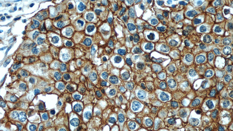 Immunohistochemistry of paraffin-embedded human lung cancer slide using Catalog No:107136(CD44 Antibody) at dilution of 1:50