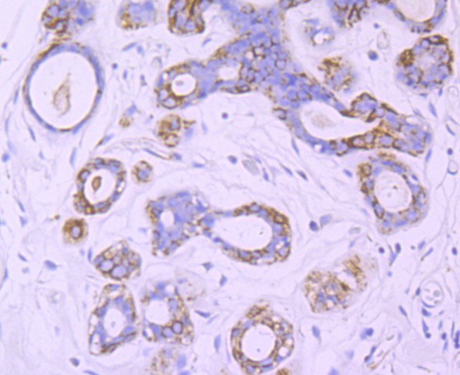 Fig6:; Immunohistochemical analysis of paraffin-embedded human breast tissue using anti-Nogo antibody. The section was pre-treated using heat mediated antigen retrieval with Tris-EDTA buffer (pH 9.0) for 20 minutes.The tissues were blocked in 1% BSA for 30 minutes at room temperature, washed with ddH; 2; O and PBS, and then probed with the primary antibody ( 1/50) for 30 minutes at room temperature. The detection was performed using an HRP conjugated compact polymer system. DAB was used as the chromogen. Tissues were counterstained with hematoxylin and mounted with DPX.