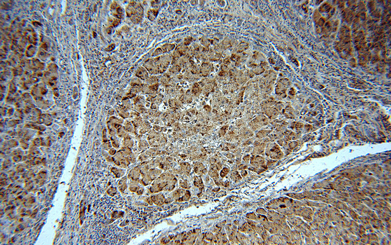 Immunohistochemical of paraffin-embedded human hepatocirrhosis using Catalog No:108885(CAT-Specific antibody) at dilution of 1:100 (under 10x lens)