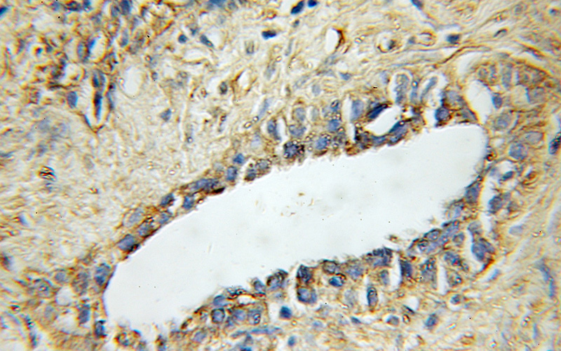 Immunohistochemical of paraffin-embedded human prostate cancer using Catalog No:115674(STAMBP antibody) at dilution of 1:100 (under 10x lens)