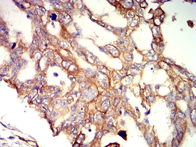 Fig4: Immunohistochemical analysis of paraffin-embedded ovarian cancer tissues using anti-APC2 antibody. The section was pre-treated using heat mediated antigen retrieval with Tris-EDTA buffer (pH 8.0) for 20 minutes. The tissues were blocked in 5% BSA for 30 minutes at room temperature, washed with ddH2O and PBS, and then probed with the primary antibody ( 1/100) for 30 minutes at room temperature. The detection was performed using an HRP conjugated compact polymer system. DAB was used as the chromogen. Tissues were counterstained with hematoxylin and mounted with DPX.