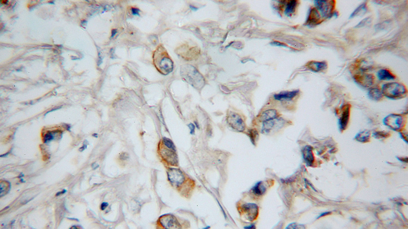 Immunohistochemical of paraffin-embedded human prostate cancer using Catalog No:110402(ERBB3 antibody) at dilution of 1:10 (under 40x lens)